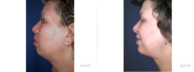 génioplastie par implant associée à une liposculpture du cou
