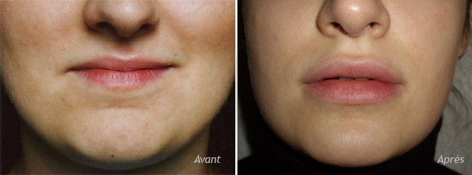 augmentation des lèvres par implants Permalip