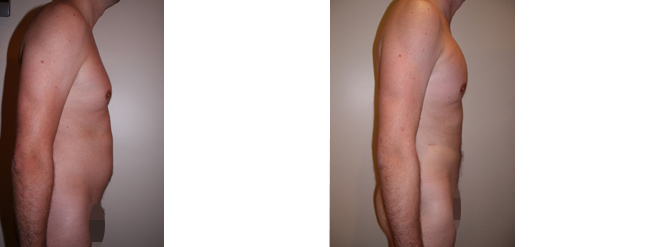 implant-pectoral-lipofilling-liposuccion-abdomen